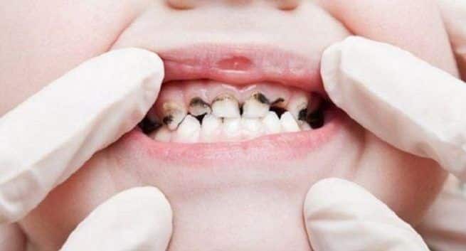 preventing tooth decay